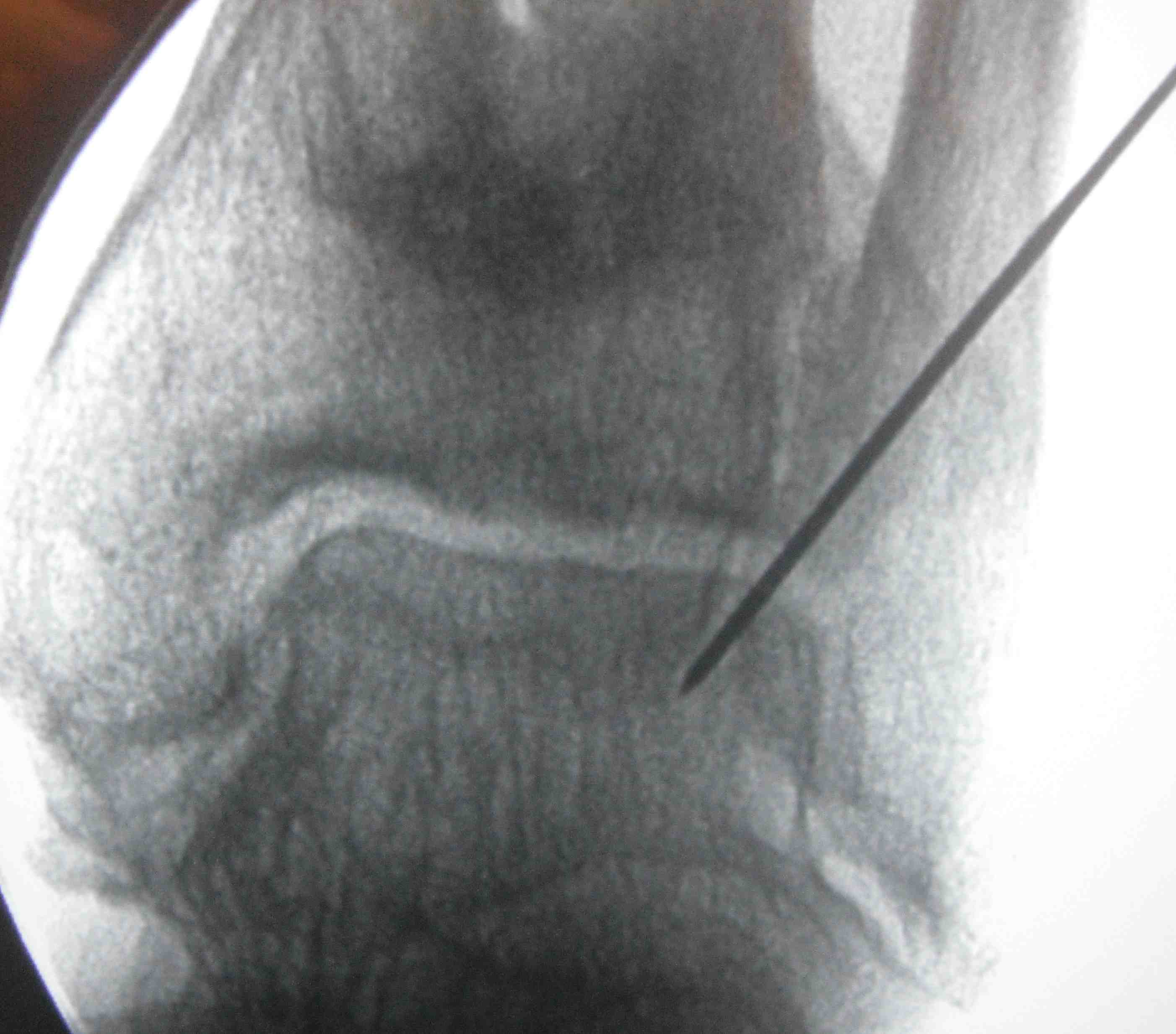 Fibula Osteotomy Ankle Fusion
